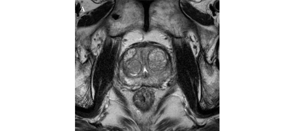 Article Of The Month MRI And Active Surveillance For Prostate Cancer BJUI