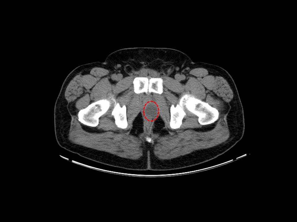 Fig 1. CT noncon SV Remnant