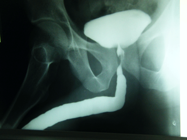 Fig.4.-retrograd-urethro-cystography