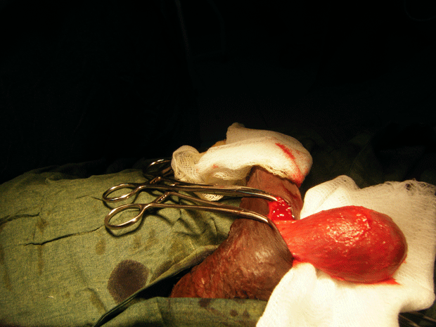 Figure2.-Appearance-of-the-cyst-after-dissection