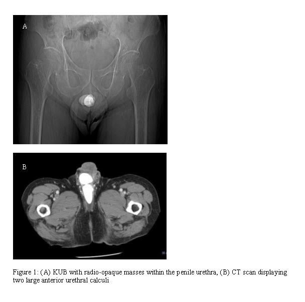 prostatic urethral calculus treatment
