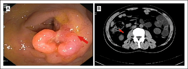 Fig1colonoscopy-and-computed-tomography-of-abdomen-