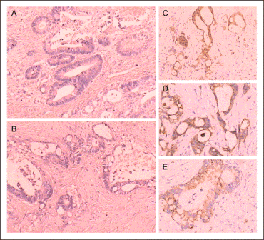 Fig3adenocarcinoma-with-lymph-node-metastases