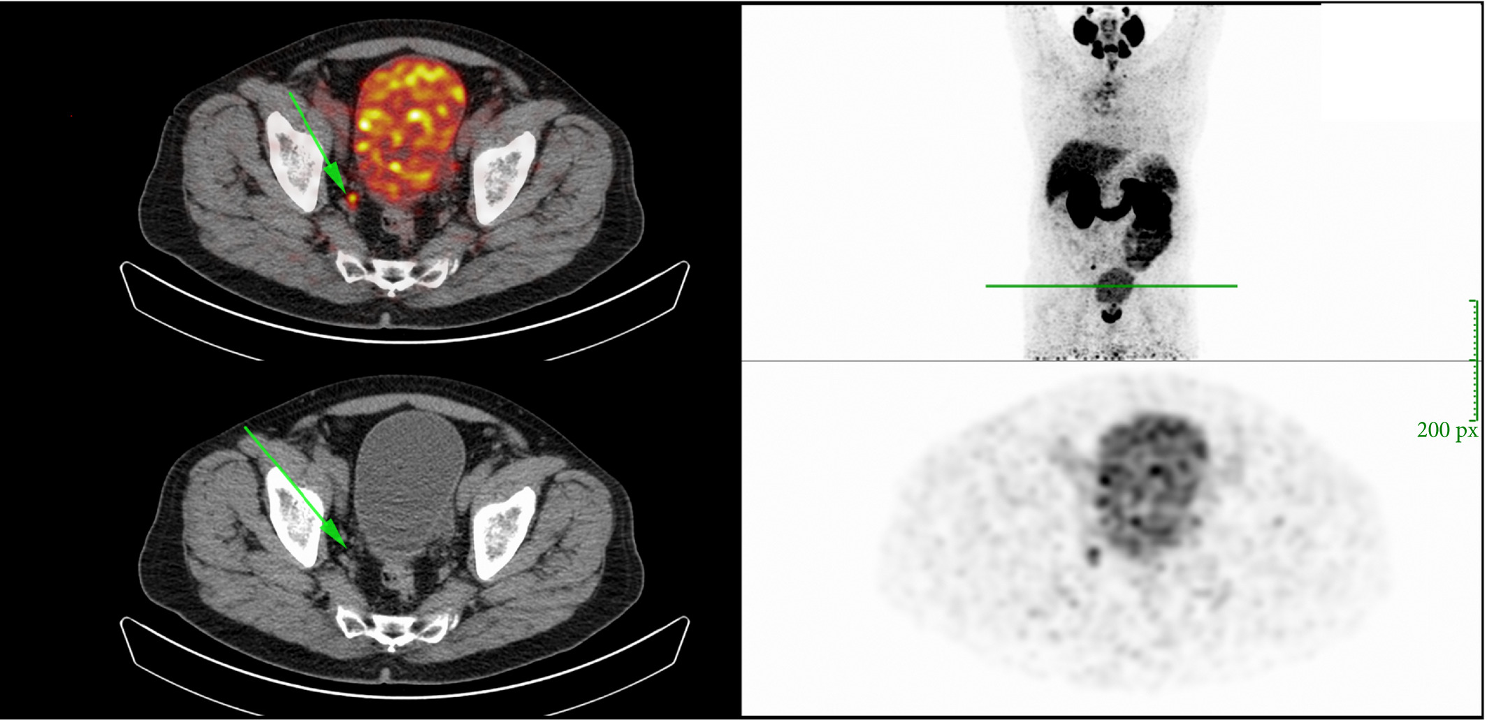 Article of the week: 68Ga‐PSMA PET/CT predicts complete biochemical